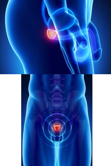 cancer-de-prostata